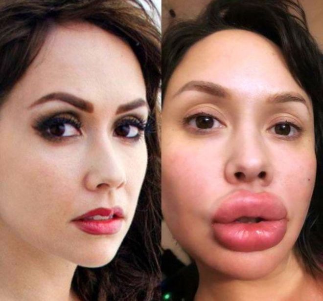Девушки которые переборщили с увеличение губ и стали похожи на уток